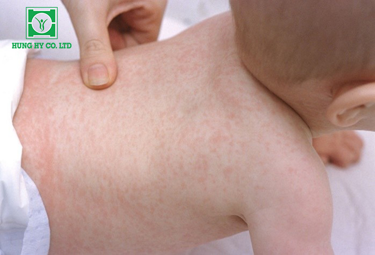 Bệnh sốt phát ban có đặc điểm là sốt cao xảy ra đột ngột và kéo dài từ 3 đến 5 ngày